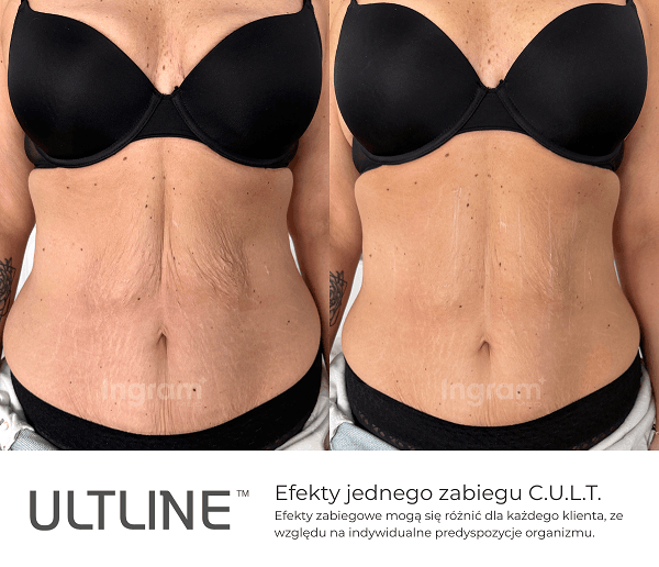Efekty kliniczne Ultline CULT